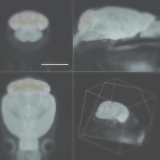 Estrogen treatment prevents gray matter atrophy in experimental autoimmune encephalomyelitis.