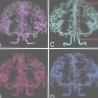 Digital reconstruction and morphometric analysis of human brain arterial vasculature from magnetic resonance angiography.