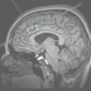 Glutamate normalization with ECT treatment response in major depression.
